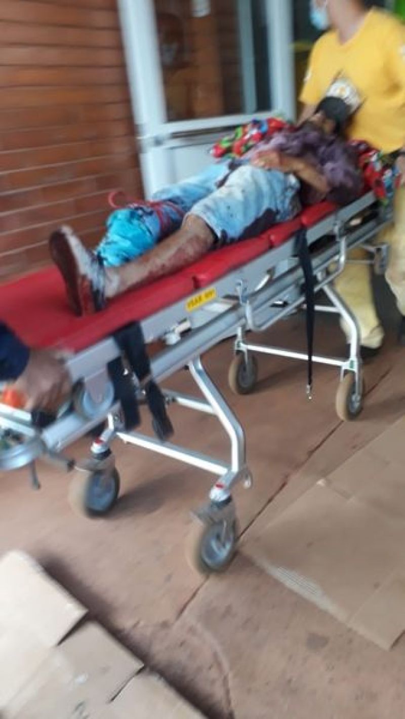Motociclista perdiÃ³ una pierna tras accidente de trÃ¡nsito