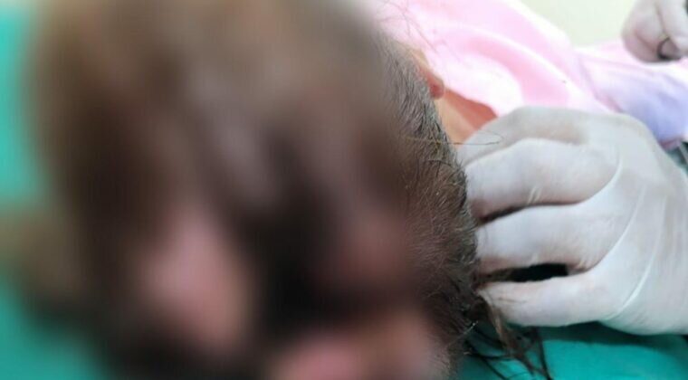 Niña de 4 años con la cabeza agusanada fue internada en hospital de CDE